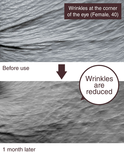 One month later, wrinkles are reduced.